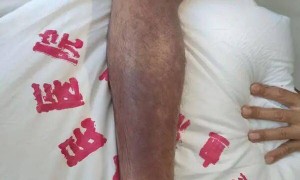 至少被3条以上毒蛇咬了10多口，26岁男子不慎踩中蛇窝，陷入休克